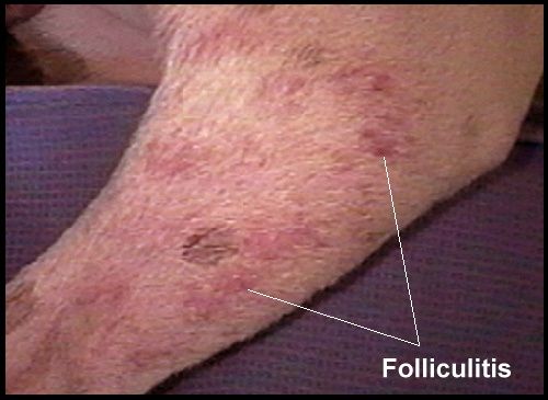 folliculitis